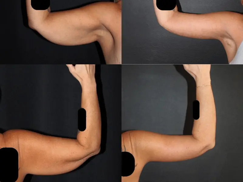 Costo del rimodellamento del corpo in Turchia: 8 fattori concreti che influenzano il prezzo Patient Discussing Arm Liposuction with Specialist