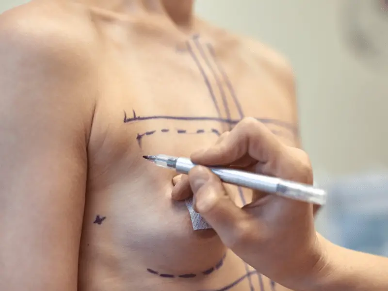 Gynecomastia Surgery Cost: 11 Reassuring Factors That Shape Your Price Personalized consultation for gynecomastia treatment