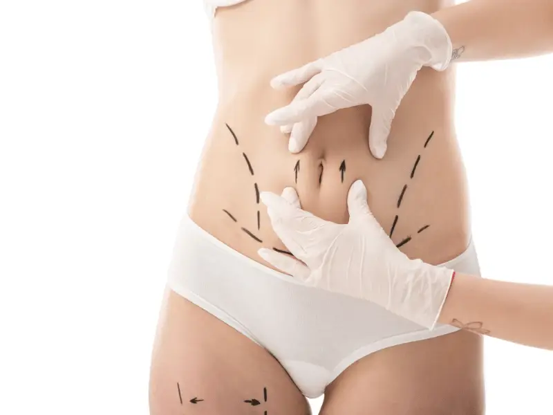 Abdominoplasty surgery At Vivid Clinic, Istanbul, Turkey