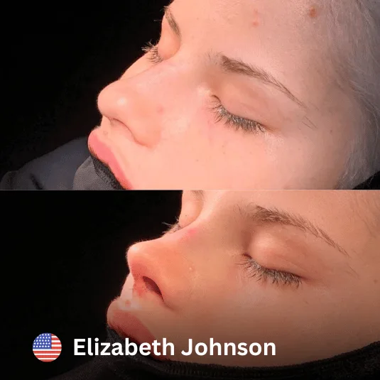 Rinoplastia en la Clínica Vivid de Estambul