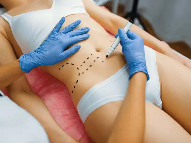 Karın Tipleri: Karnınızın Görünümünün Nedenleri Vivid Clinic'te doğum sonrası karın ve karın kası ayrılması için kişiselleştirilmiş konsültasyon.