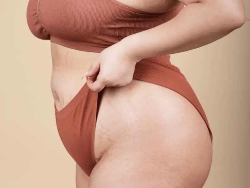 胃球囊火鸡:蜕变前8个令人安心的见解 visualizing post-gastric sleeve transformation