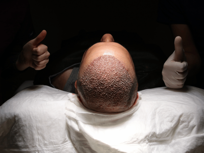 DHI-Haartransplantation: 8 wichtige Erkenntnisse vor Ihrer Transformation Ein Patient liegt bequem, während er sich in der Vivid Clinic einer DHI-Haartransplantation unterzieht.