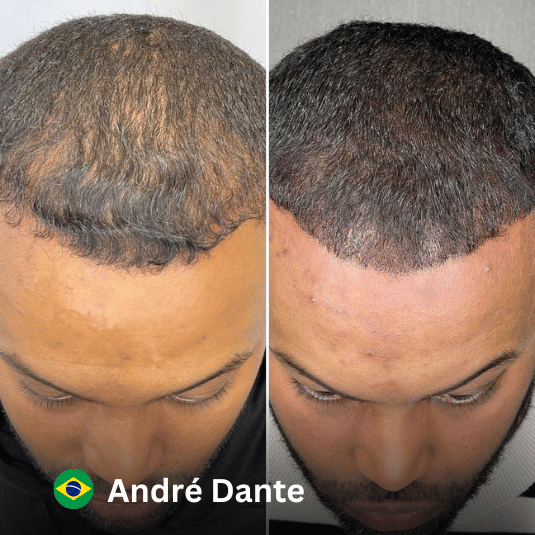 Hair Transplantation at Vivid Clinic