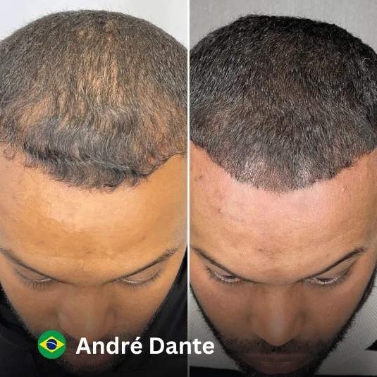Trasplante de cabello en Vivid Clinic
