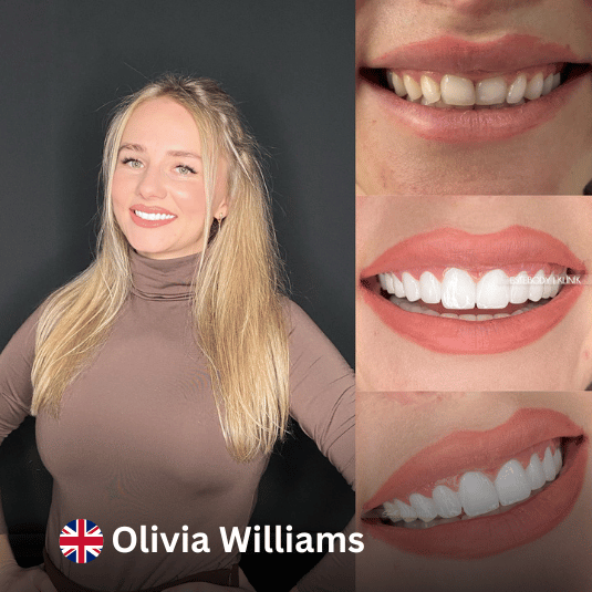 Hollywood Smile at Vivid Clinic Istanbul