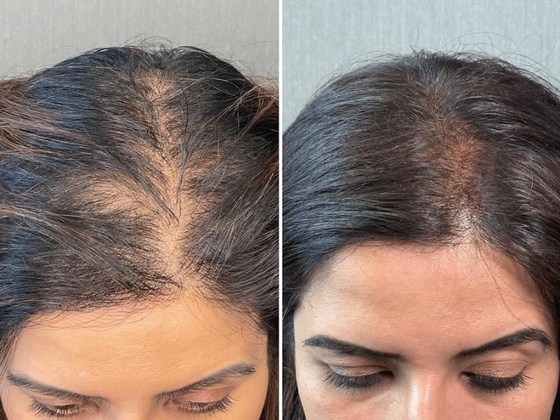 Trasplante capilar para mujeres: 10 consejos tranquilizadores antes de tu transformación. Side by side comparison of a female patient’s hair before and after a hair transplant at vivid clinic