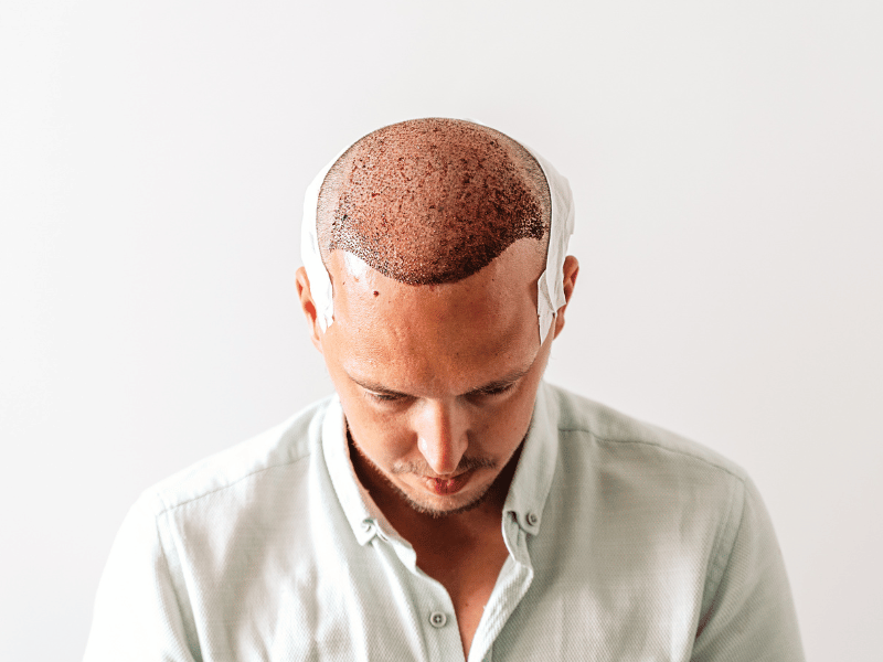 تقنية زراعة الشعر بتقنية اقتطاف الياقوت: 6 نصائح أساسية قبل عملية التحول a close-up of a patient’s scalp with hairline markings before undergoing dhi hair transplant at vivi