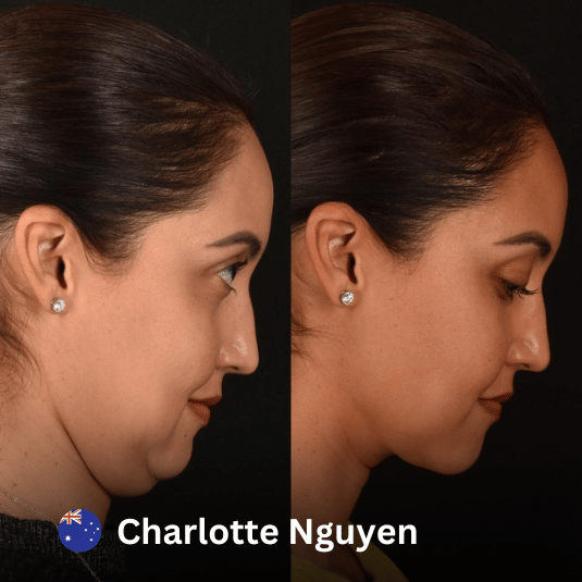 Chin Liposuction At Vivid Clinic Istanbul