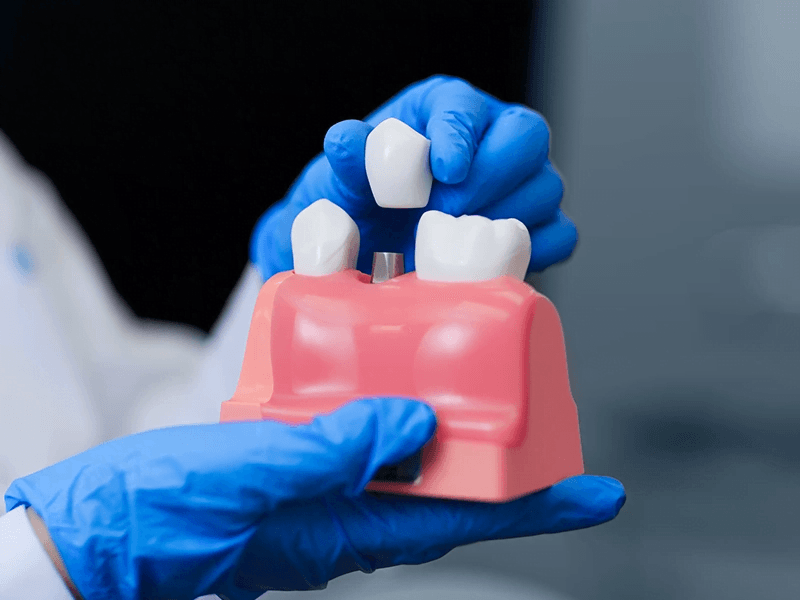 Tandkronen in Turkije: 9 betrouwbare tips vóór uw transformatie Dental crowns what to expect