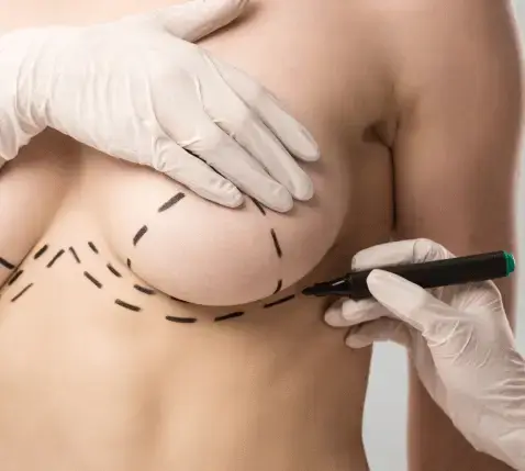 Breast Lifting (Mastopexy) at Vivid Clinic, Istanbul, Turkey