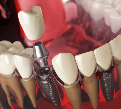 Dental Implant Equipment: A close-up shot of the advanced dental implant equipment used at Vivid Clinic, showcasing the high-tech tools and sterile environment.