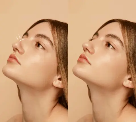 Rhinoplasty Before and After Side Profile