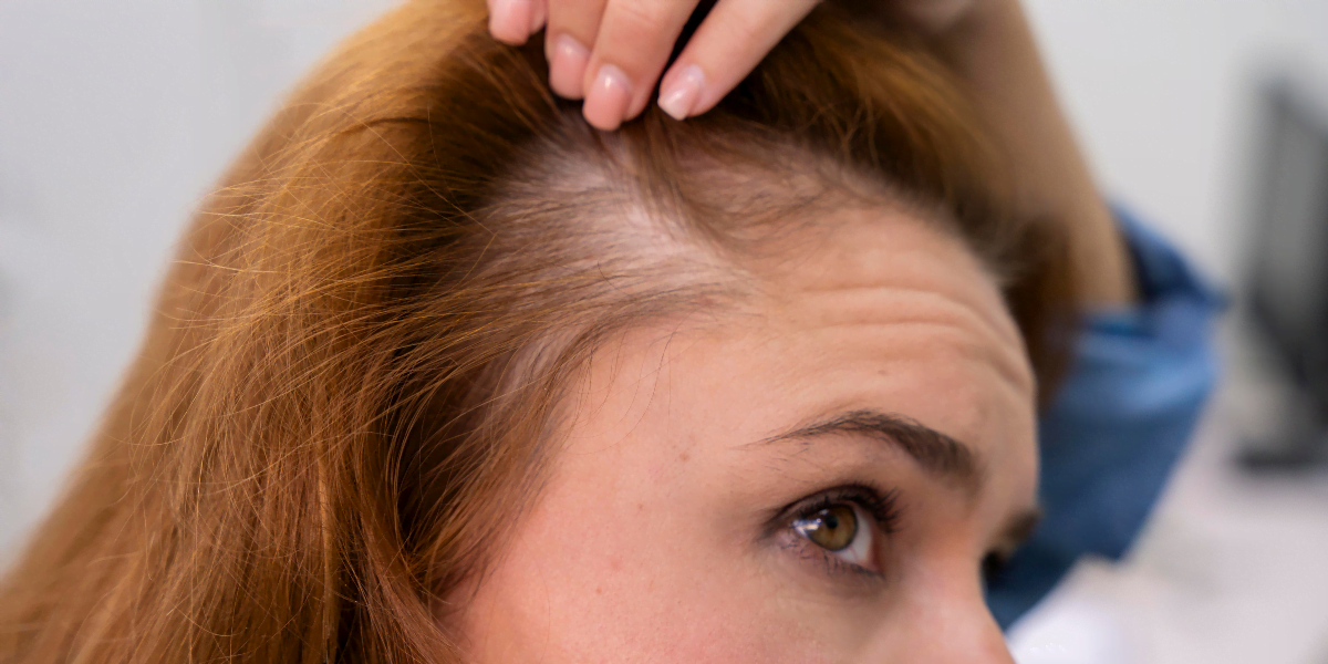 Trasplante capilar para mujeres: 10 consejos tranquilizadores antes de tu transformación. Hair follicles being prepared under a microscope for transplantation at vivid clinic