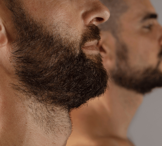 Man contemplating Beard Transplant options