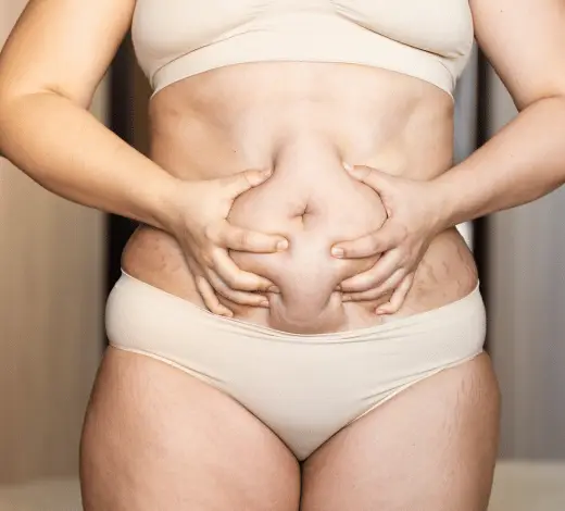 Gastric bypass surgery involves creating a small pouch at the top of the stomach and connecting it directly to the small intestine.