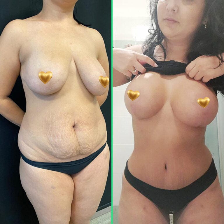 Mommy Makeover in Turkey Front-view before and after composite of a mommy makeover with breast implants and abdominoplasty