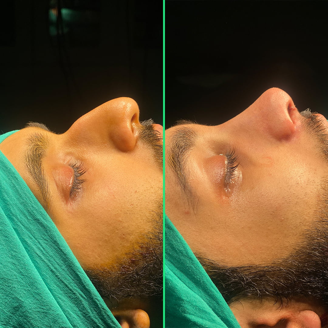 Before and after results showing a refined, masculine nose shape after rhinoplasty surgery for men at Vivid Clinic