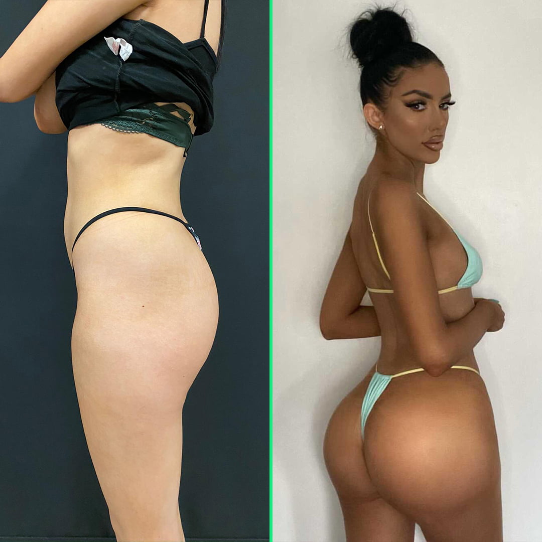 Post-surgery results of butt implants showing enhanced, fuller, and rounded glutes after gluteal augmentation at Vivid Clinic