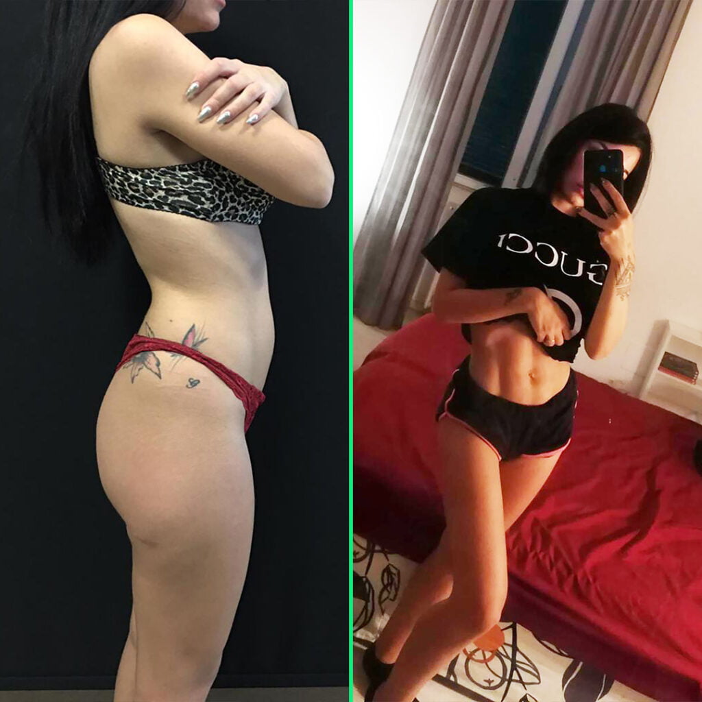 Liposuction in Istanbul - Vivid Clinic Before and after results highlighting a sculpted waistline and natural-looking, lifted buttocks after high-definition liposuction and skinny BBL at Vivid Clinic