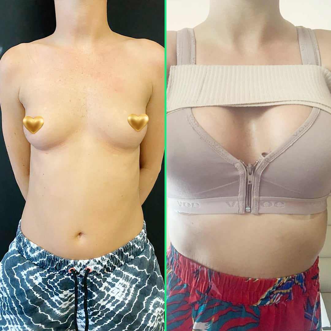 Before and after results of breast augmentation showing fuller, enhanced breasts with implants, performed at Vivid Clinic.