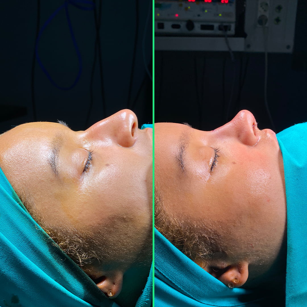 Before and after results showing a refined, natural-looking nose shape after rhinoplasty surgery for women at Vivid Clinic