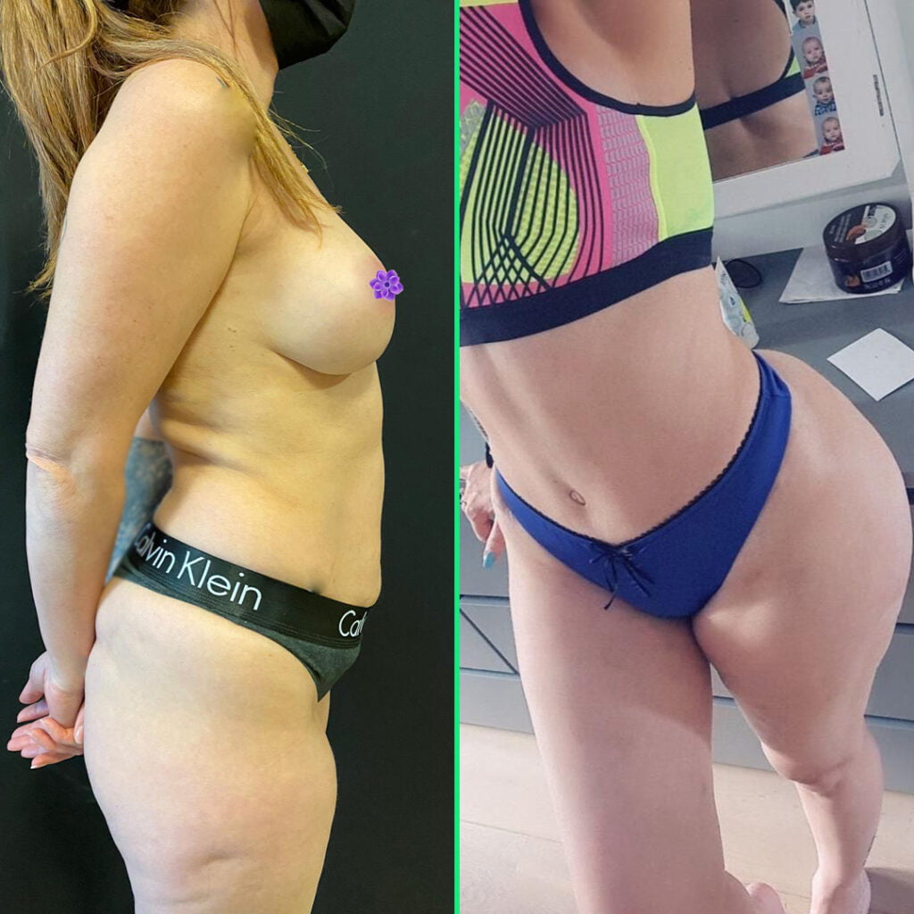 Tummy Tuck Surgery in Istanbul - Vivid Clinic Post-surgery results of abdominoplasty showing a firm, smooth abdomen with tightened skin and muscle repair at Vivid Clinic.