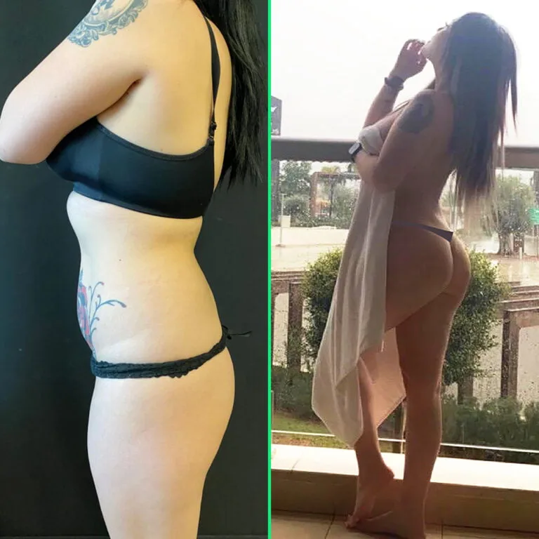 Vorher-Nachher-Ergebnisse zeigen eine geformte Taille und einen volleren, angehobenen Po nach einer Fettabsaugung und einem Brazilian Butt Lift (BBL) in der Vivid Clinic