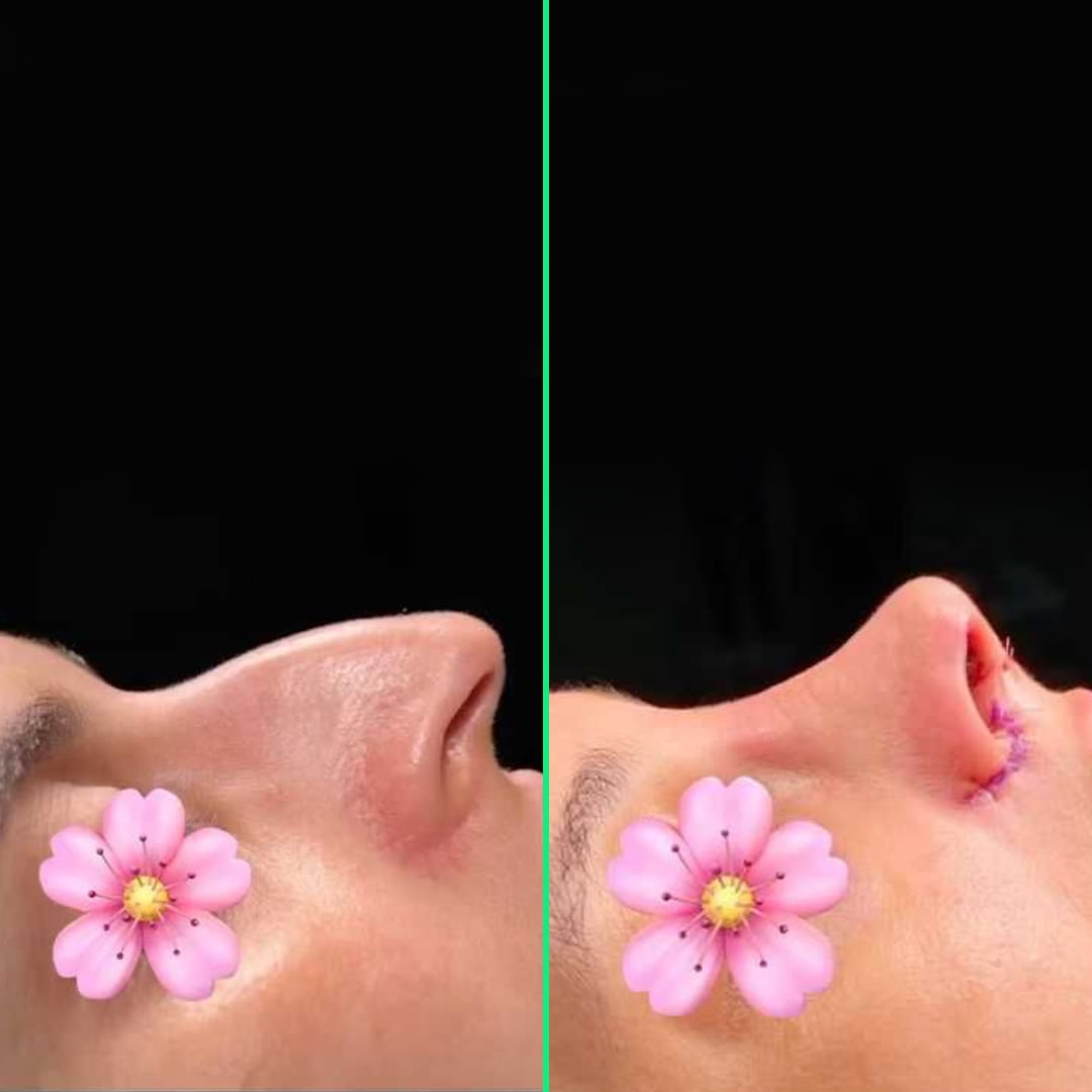 Refined and balanced nose shape after rhinoplasty surgery at Vivid Clinic.