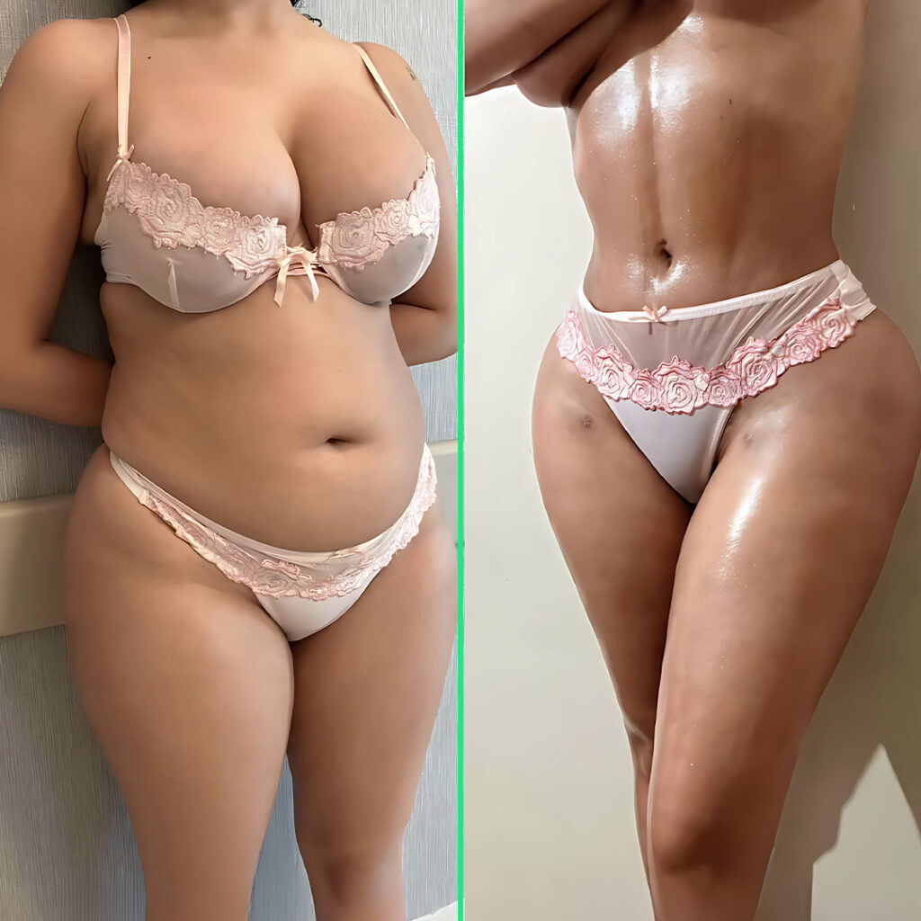 Defined waist and fuller, lifted buttocks after high-definition liposuction and Brazilian Butt Lift (BBL) at Vivid Clinic