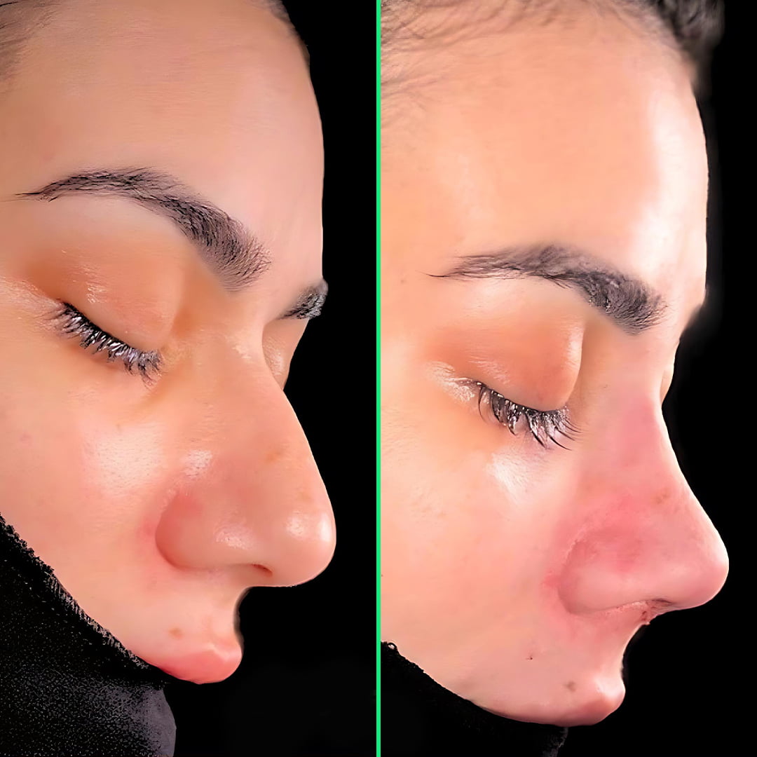 Natural-looking nose after rhinoplasty surgery for women at Vivid Clinic.