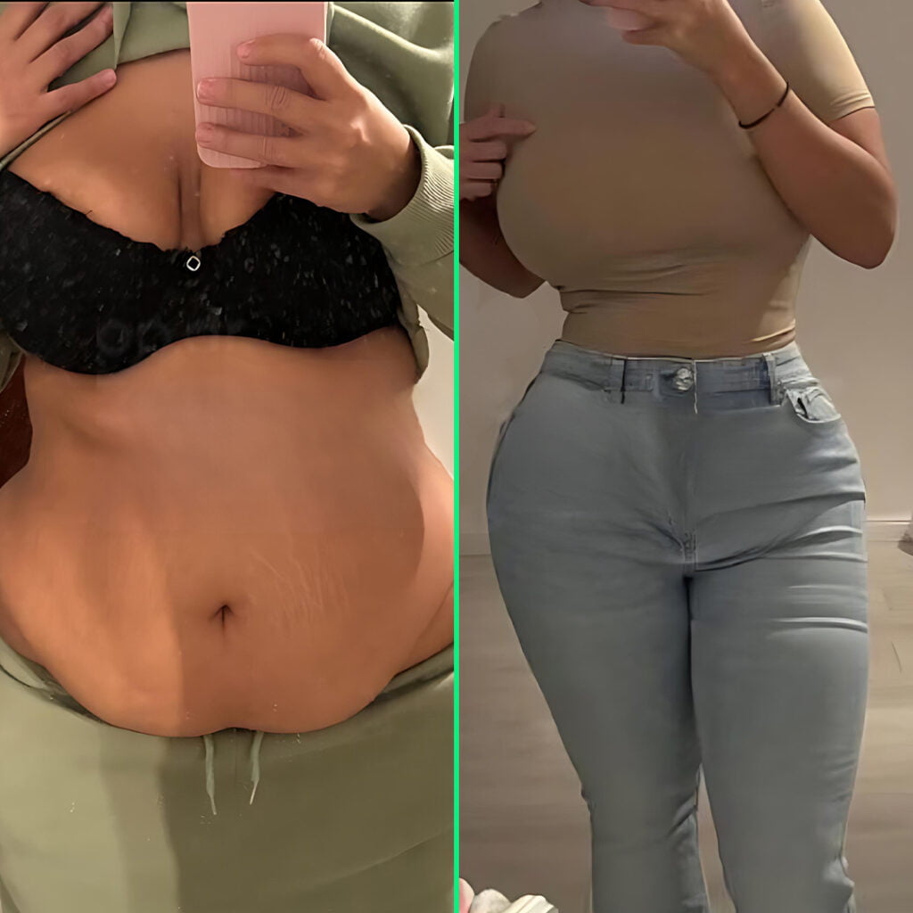 Post-surgery results showing a flatter abdomen and enhanced, lifted breasts with implants after a mommy makeover at Vivid Clinic.