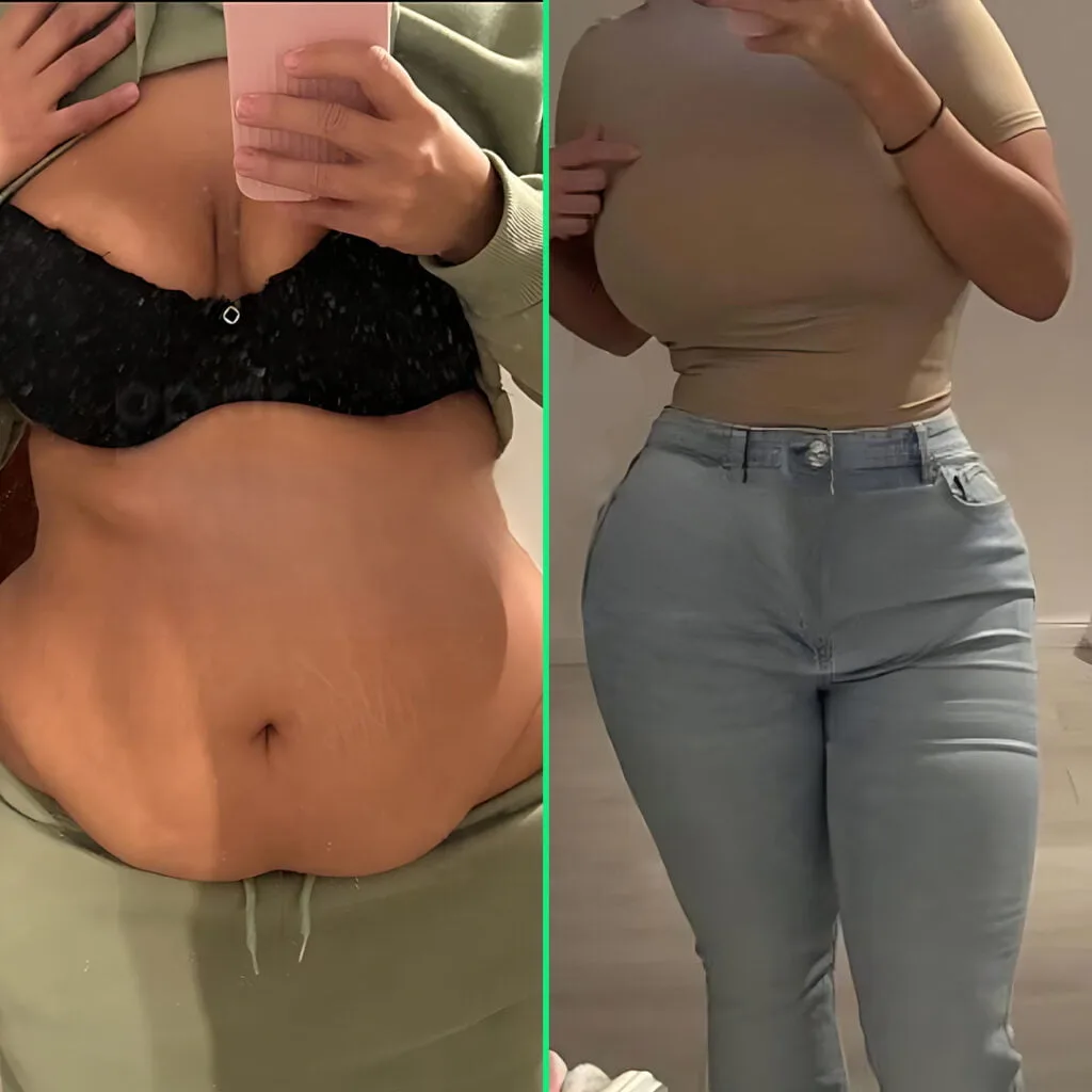 Hanging Belly After a C-Section: 7 Proven Ways to Tighten & Tone Your Tummy Post-surgery results showing a flatter abdomen and enhanced, lifted breasts with implants after a mommy makeover at Vivid Clinic.