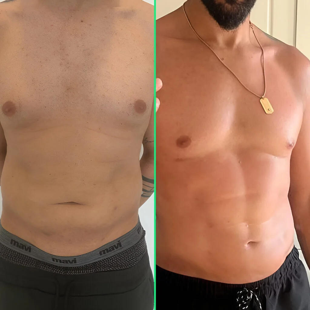 Defined six-pack abs and sculpted waist after six-pack surgery with HD liposuction at Vivid Clinic