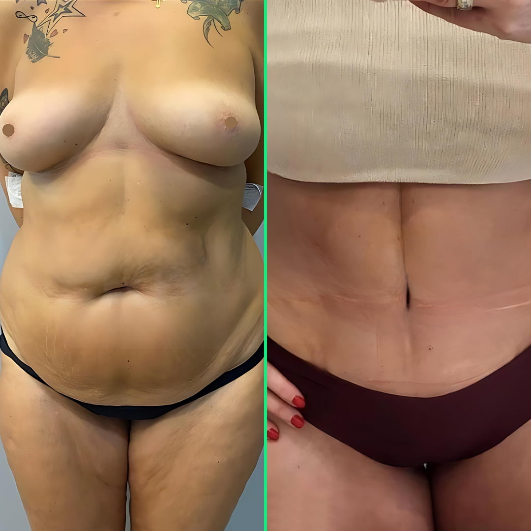 Flatter, toned abdomen after abdominoplasty (tummy tuck) surgery at Vivid Clinic.