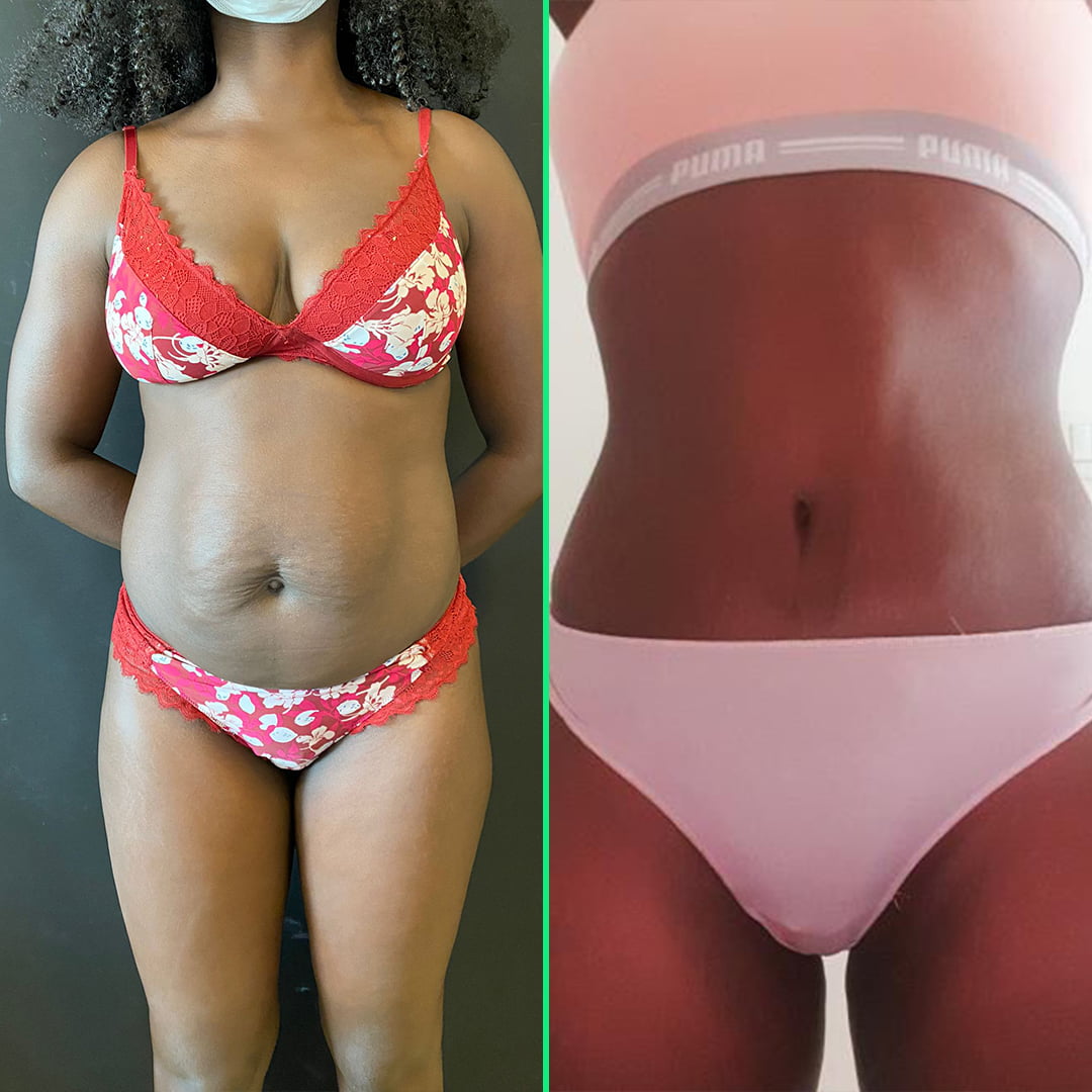 Before and after results showing a flatter, toned abdomen following abdominoplasty (tummy tuck) surgery at Vivid Clinic