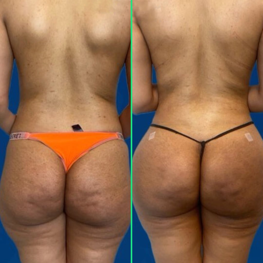 Post-surgery results showing enhanced, lifted buttocks with a Brazilian Butt Lift (BBL) and implants at Vivid Clinic