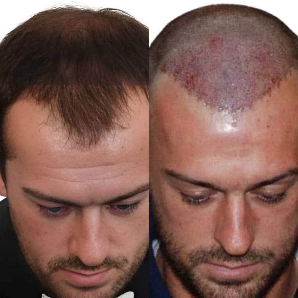 What did Zane Hijazi share about his hair transplant journey?