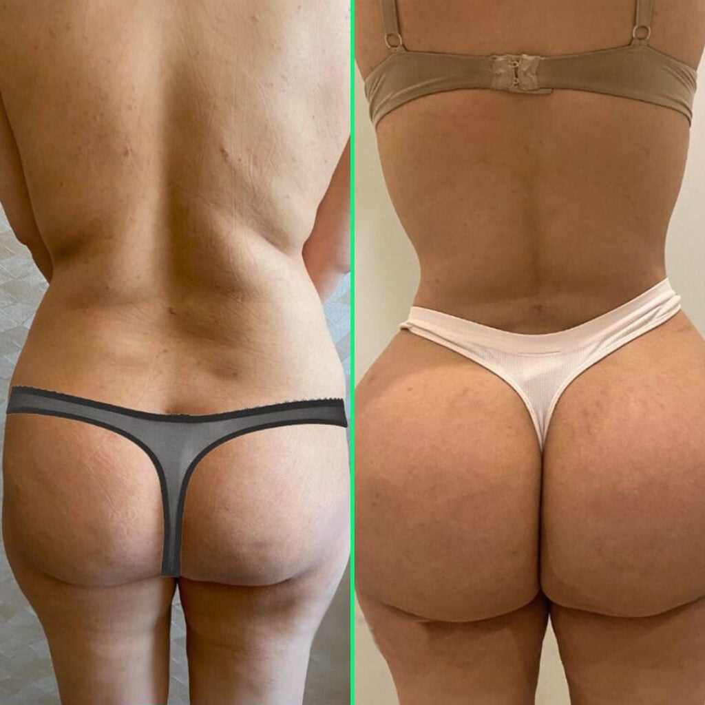 Shaped waist and fuller buttocks after liposuction with fat injection to the buttocks at Vivid Clinic