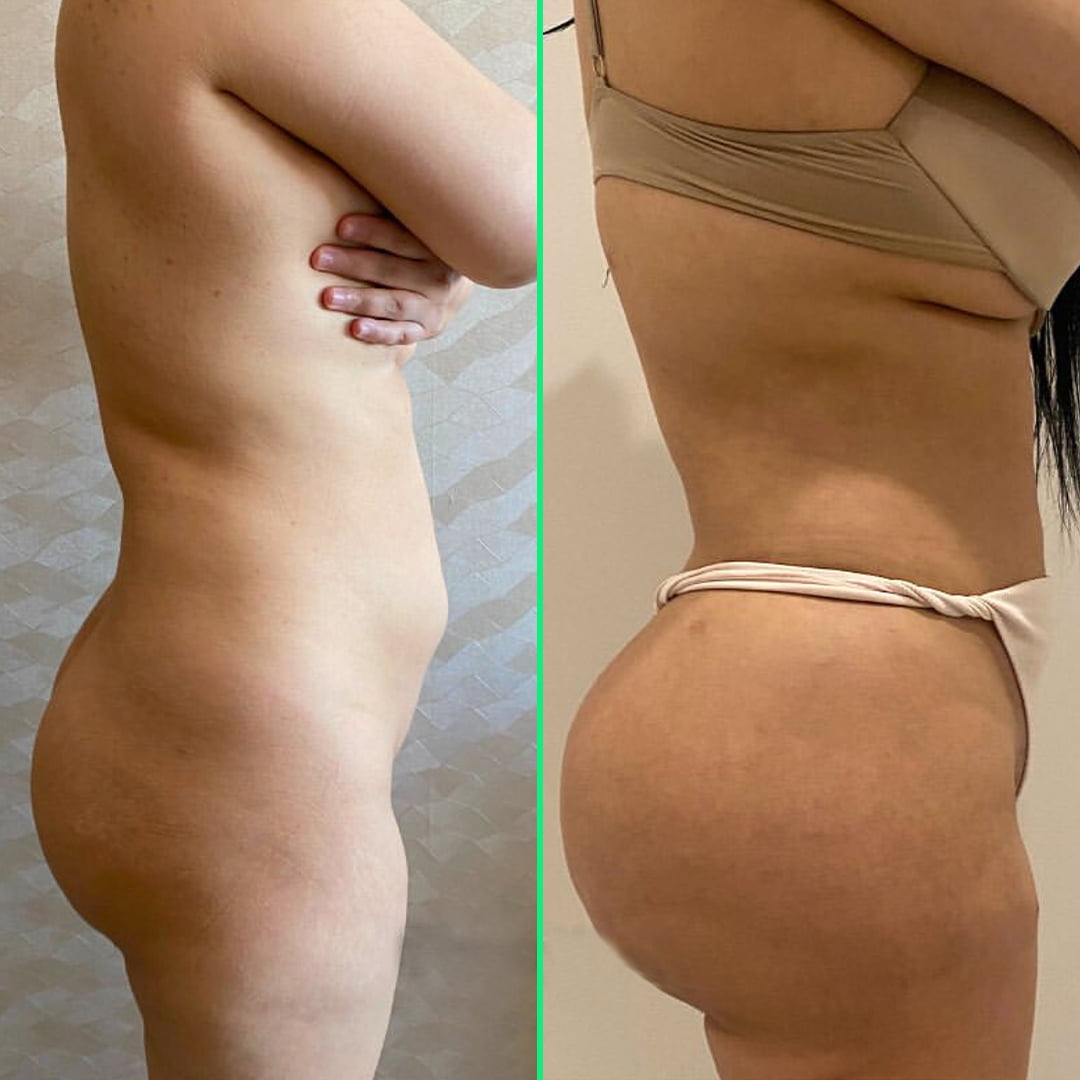 Enhanced and fuller buttocks after fat injection surgery at Vivid Clinic