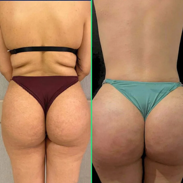 Glatter, geformter Rücken und volleres, angehobenes Gesäß nach einer Fettabsaugung am Rücken und einem Brazilian Butt Lift (BBL) in der Vivid Clinic