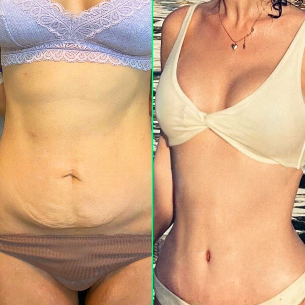 Tummy Tuck Surgery in Istanbul - Vivid Clinic Post-surgery results of a toned abdomen and contoured waist after high-definition liposuction and tummy tuck at Vivid Clinic