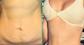 Get a Flatter Stomach with Tummy Tuck Surgery in Istanbul