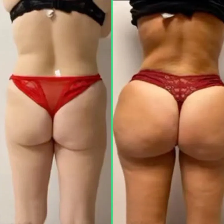 Ganzkörperkonturierungsergebnisse mit 360-Grad-Fettabsaugung und Brazilian Butt Lift (BBL) in der Vivid Clinic