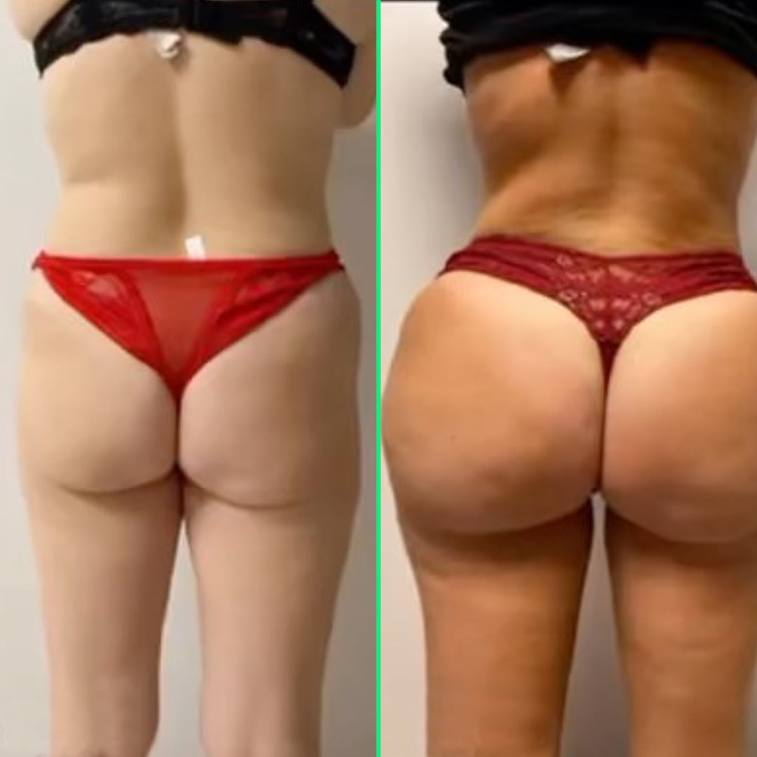 Full-body contouring results with 360 liposuction and Brazilian Butt Lift (BBL) at Vivid Clinic