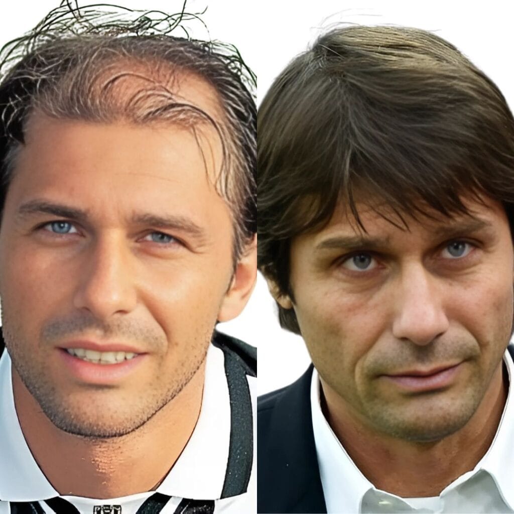 How Antonio Conte Tackled Hair Loss Over the Years