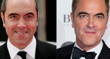 Celebrities Hair Transplants: Why Celebrities Love DHI Technique