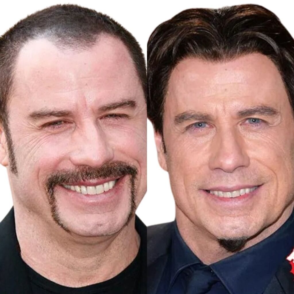 John Travolta's discreet celebrity hair transplants results.