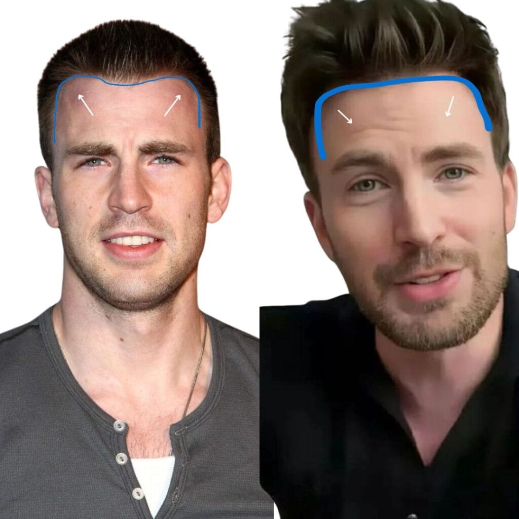 Chris Evans' Hairline Transformation