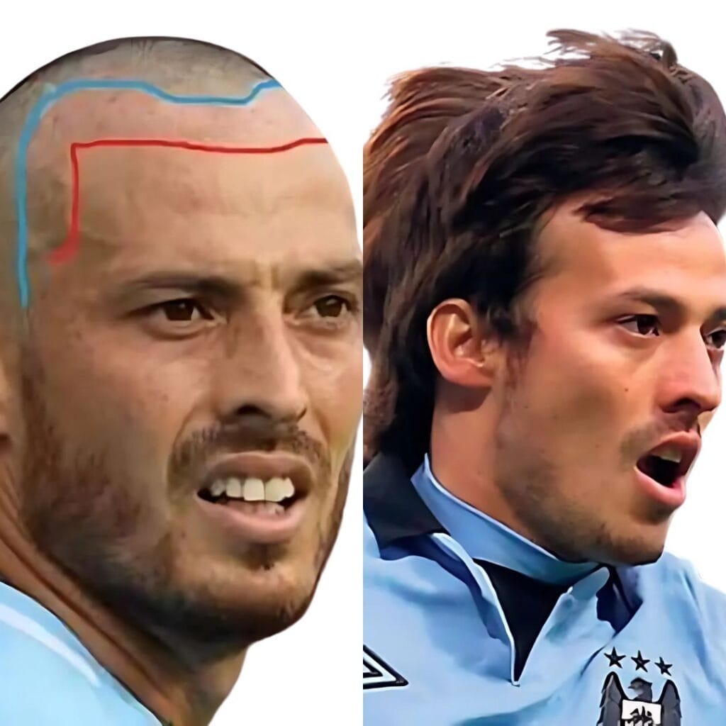 What evidence exists of David Silva's hair transplant procedure?